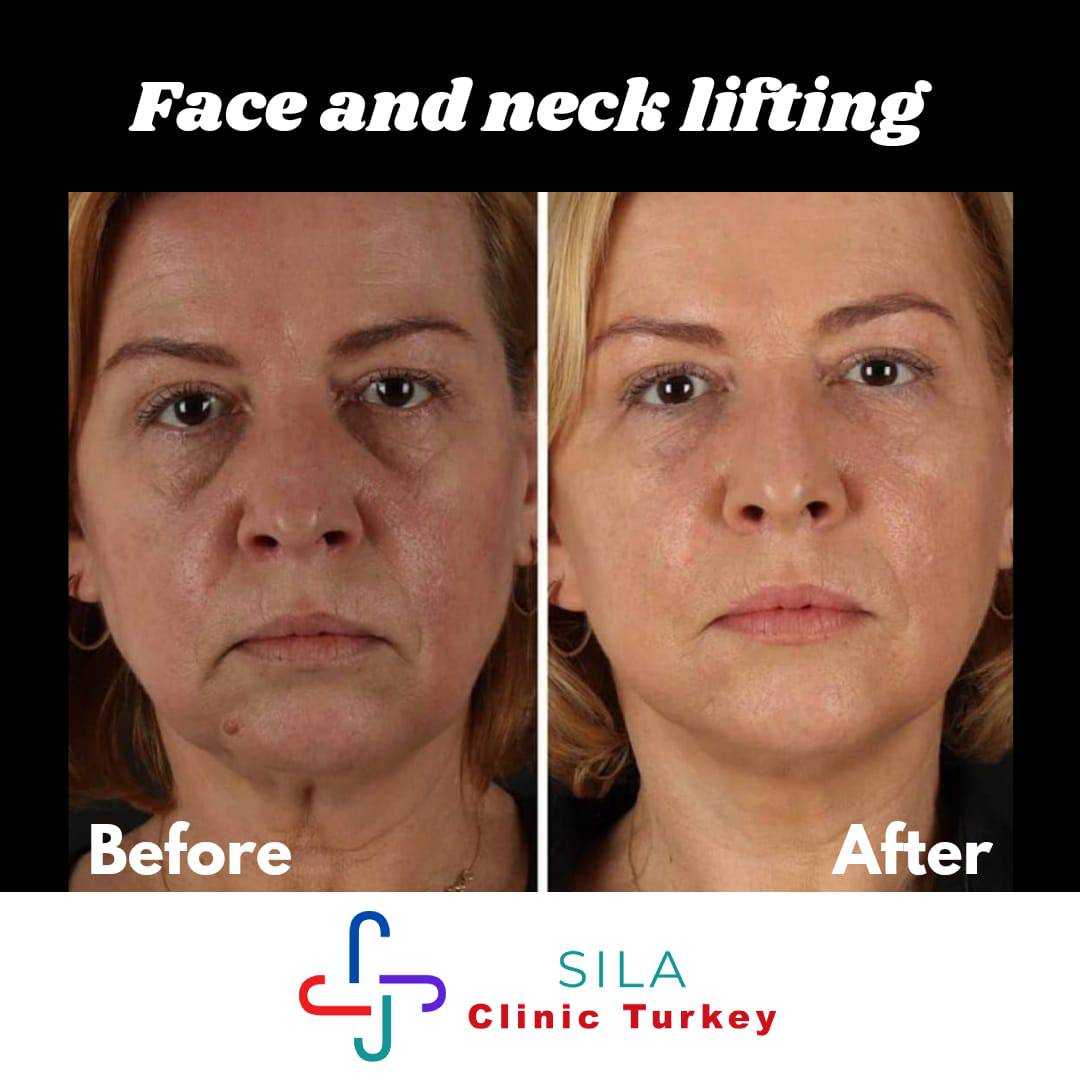 Yüz Germe - Image 1