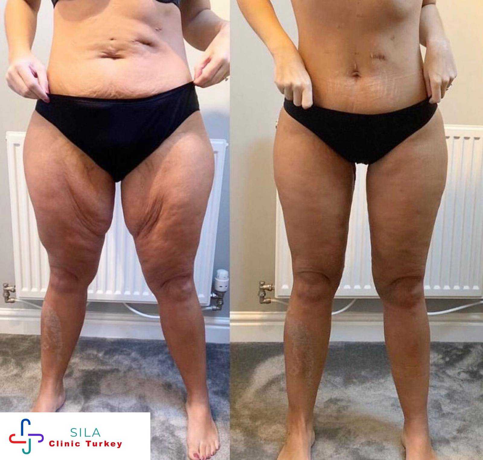 Bacak Germe - Before After