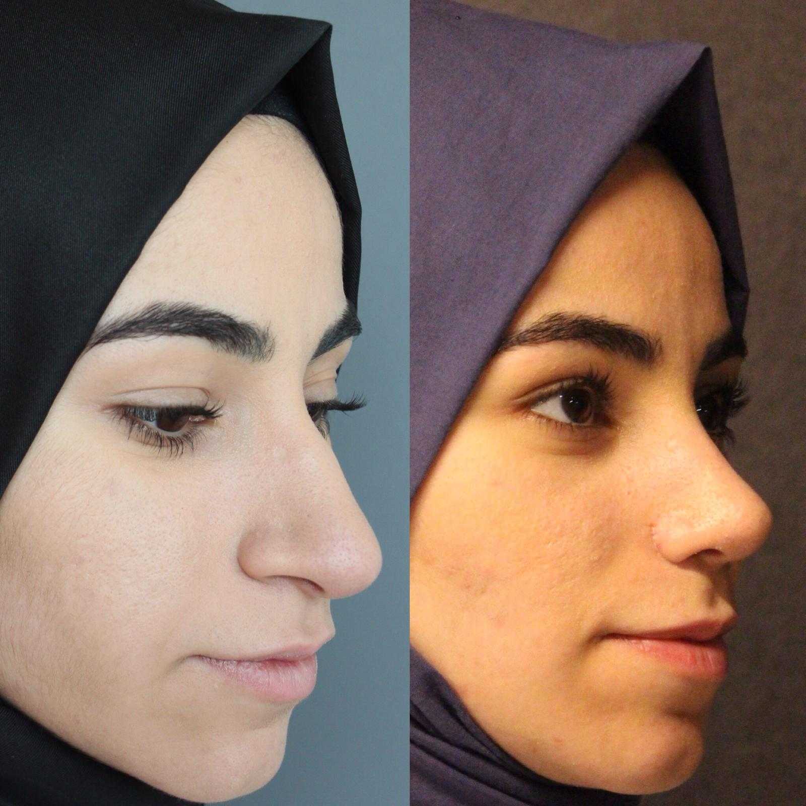 Burun Estetiği -  Image 2