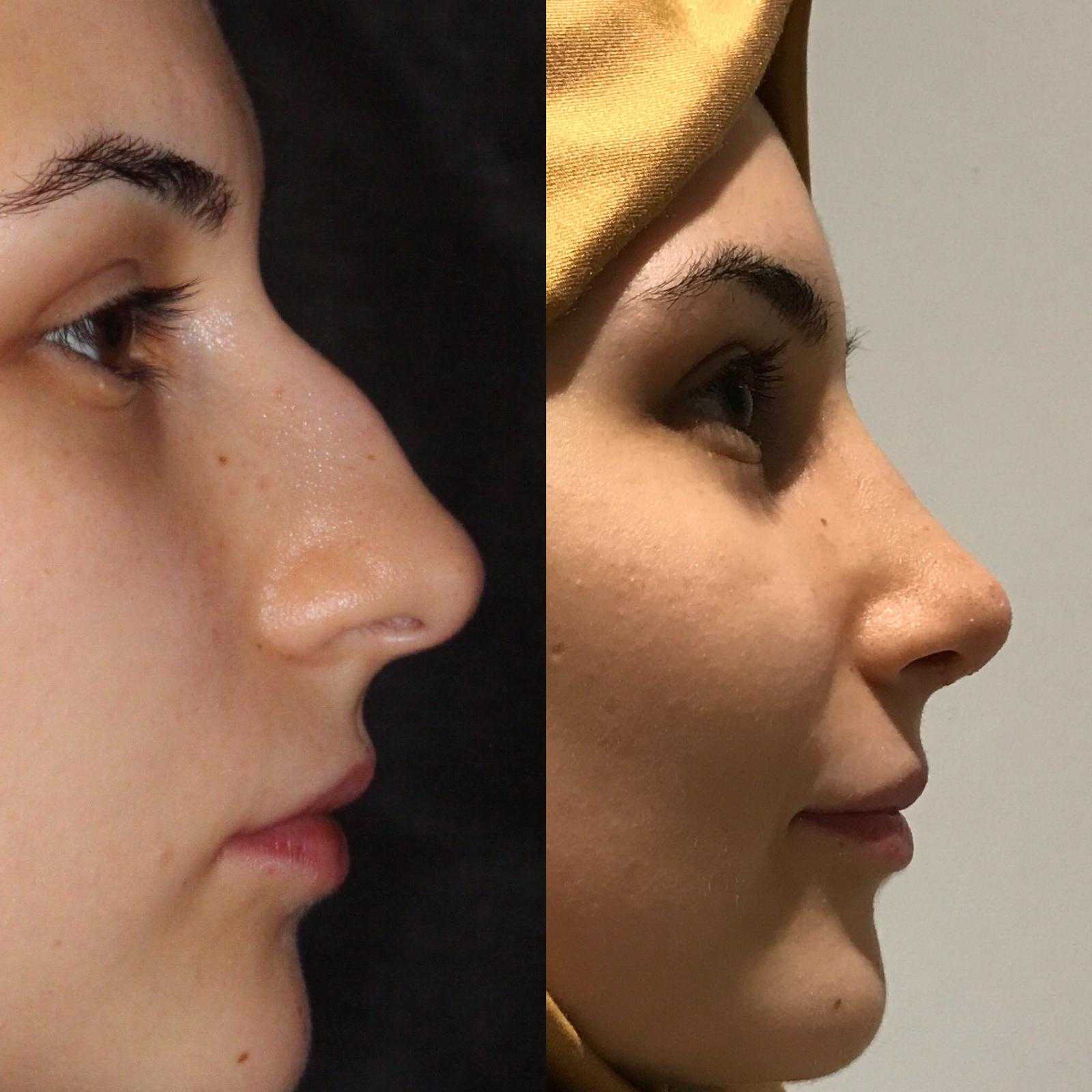 Burun Estetiği -  Image 1