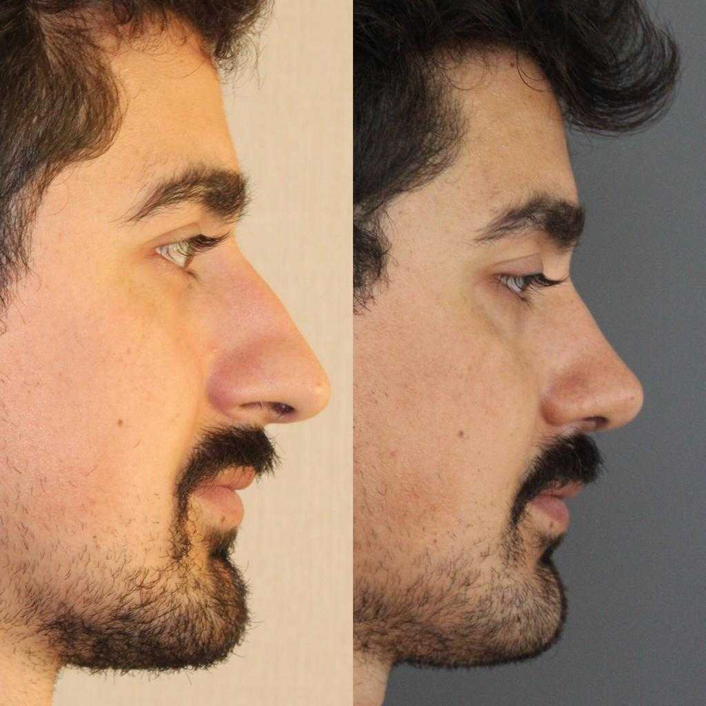 Burun Estetiği - Before After
