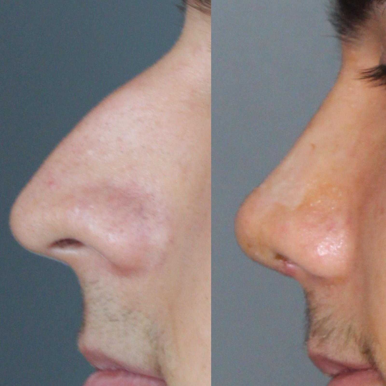 Burun Estetiği -  Image 3