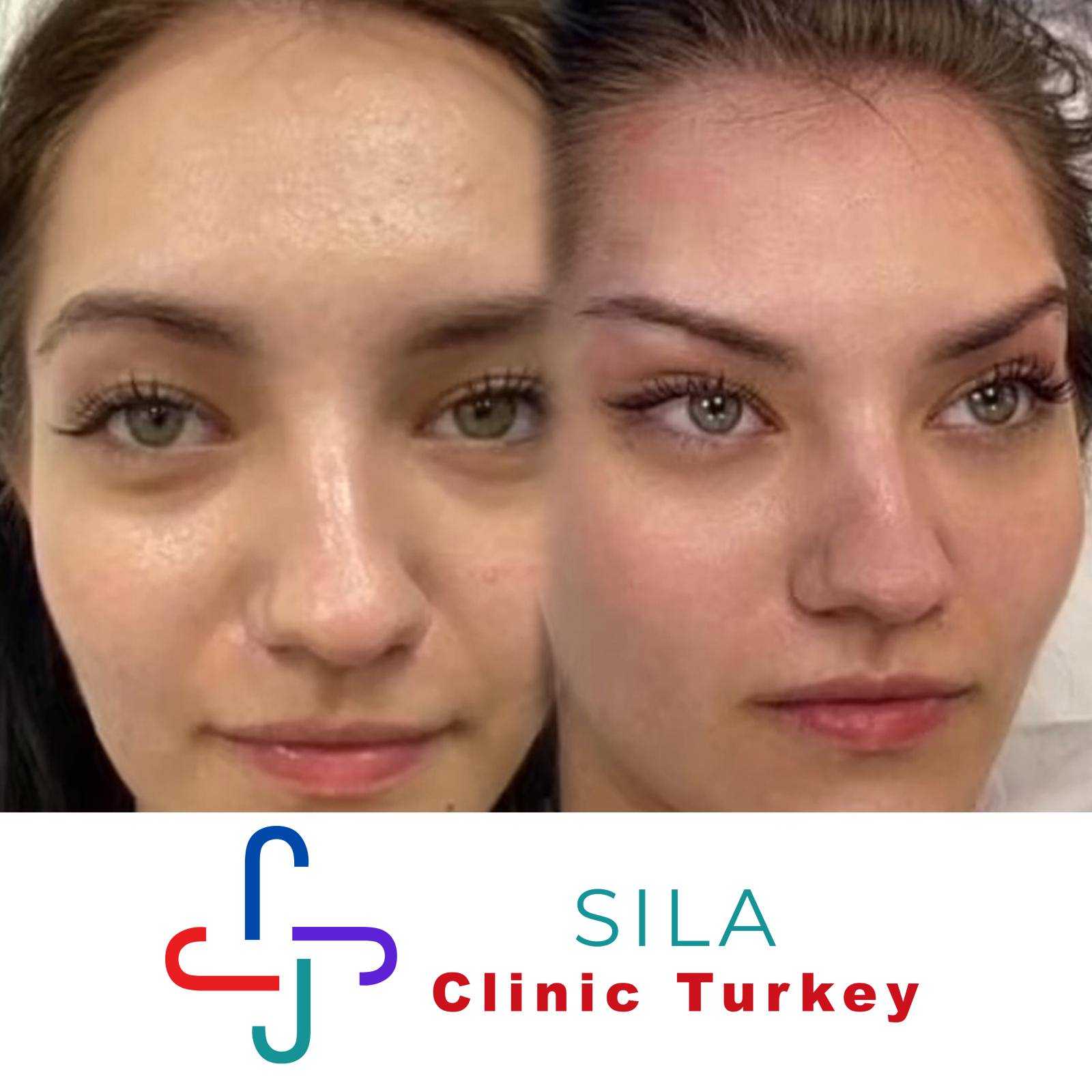 Kedi Gözü Estetiği - Before After