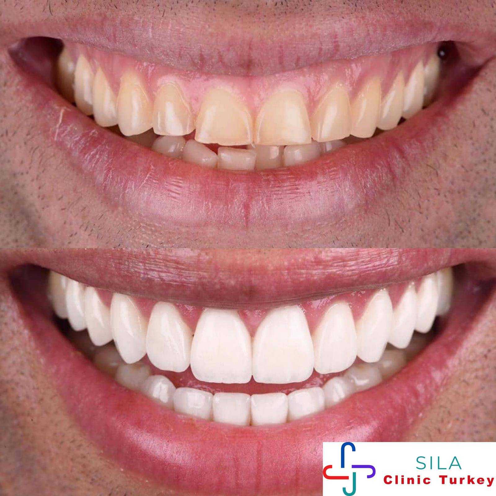 Lamina Kaplamalar -  Image 1