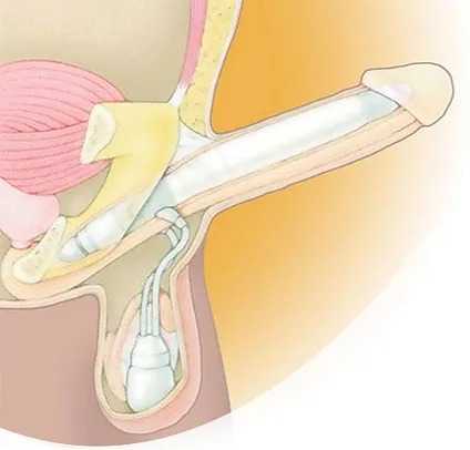 Penis Kalınlaştırma - Before After