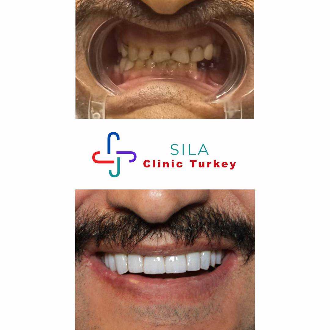 Zirkonyum Kaplama -  Image 1