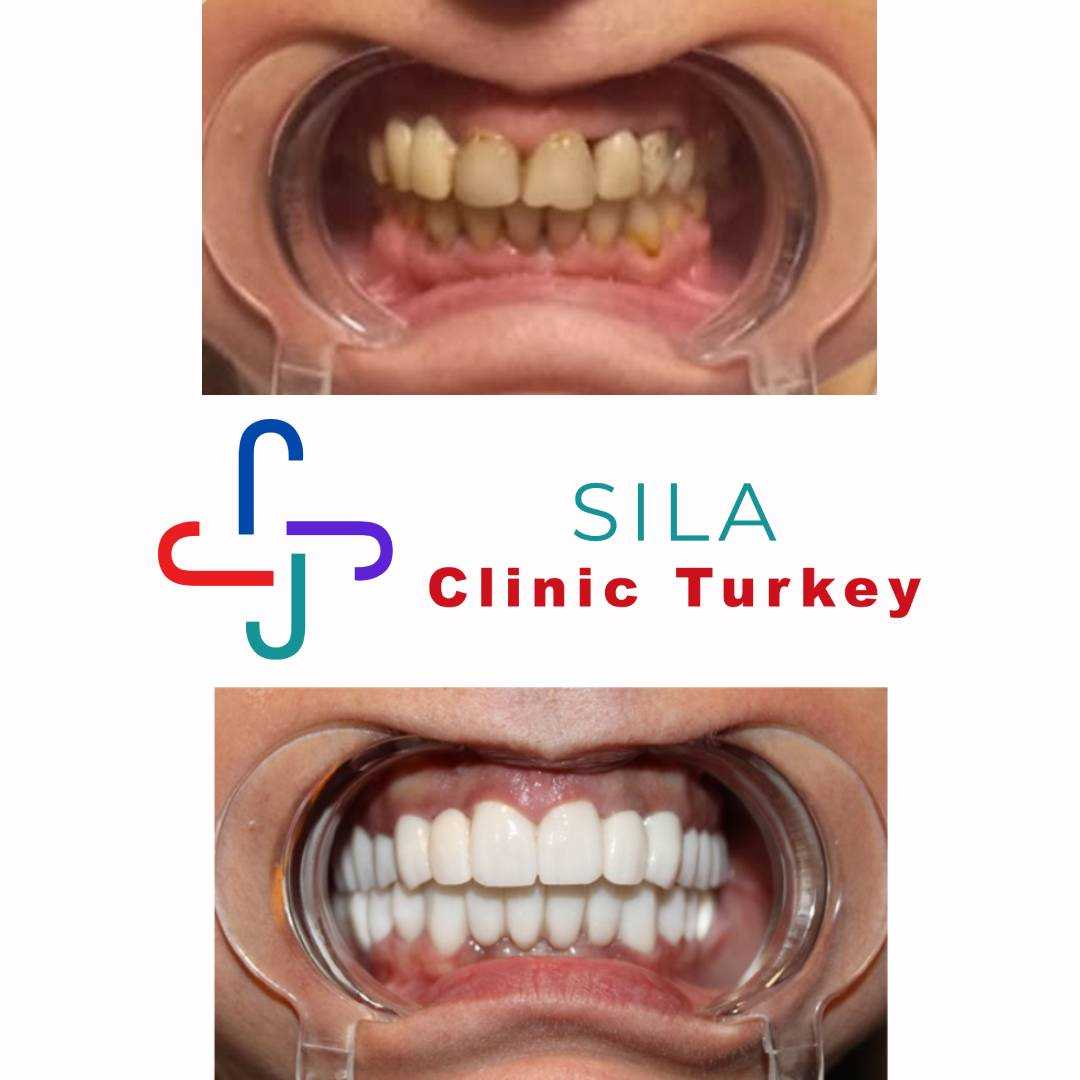 Zirkonyum Kaplama -  Image 2