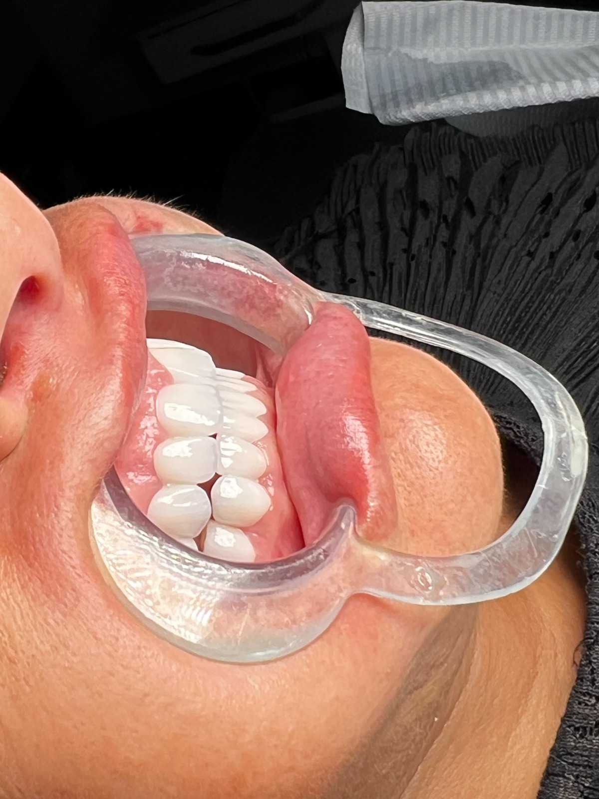 Diş Temizleme - Before After