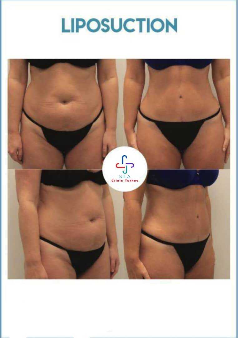 Liposuction - Before After