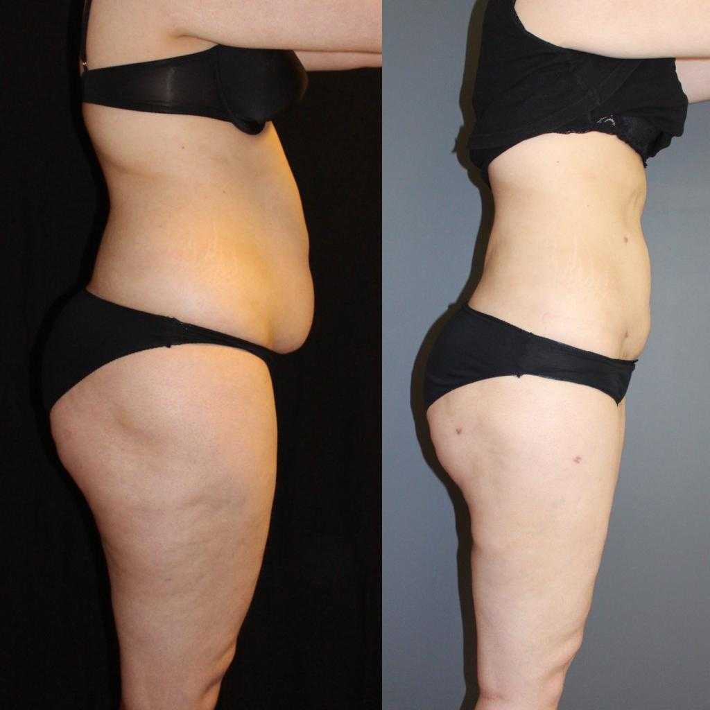 Liposuction -  Image 4