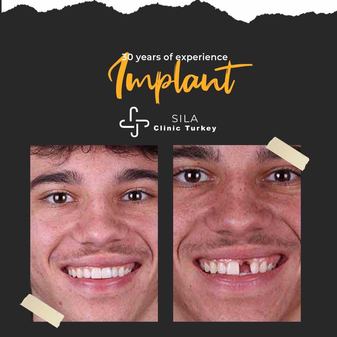 Diş İmplantı - Before After