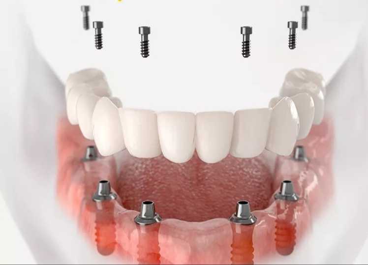 Diş İmplantı -  Image 2