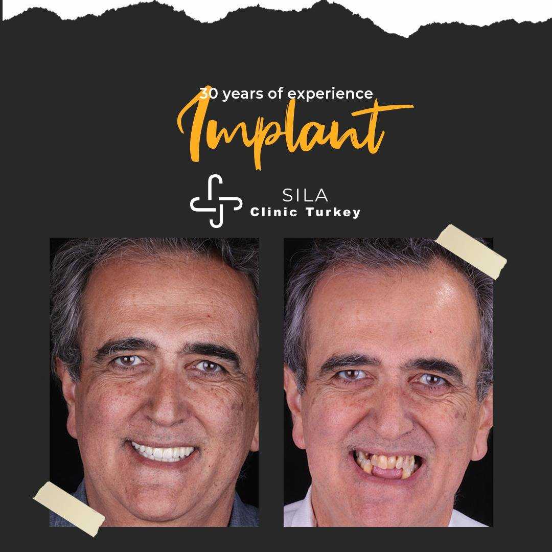 Diş İmplantı -  Image 1