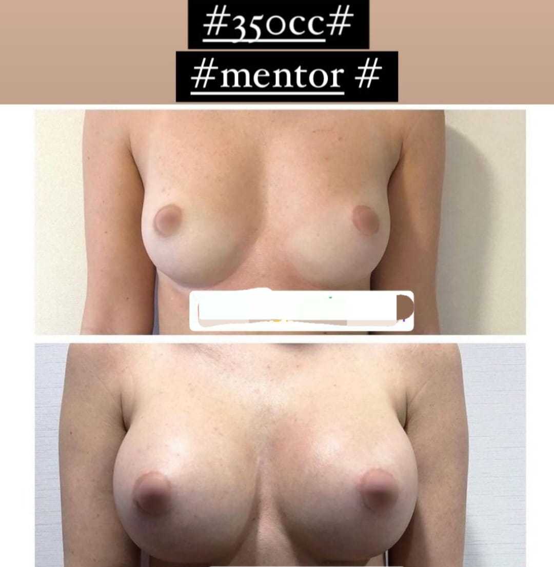 Meme Büyütme -  Image 2