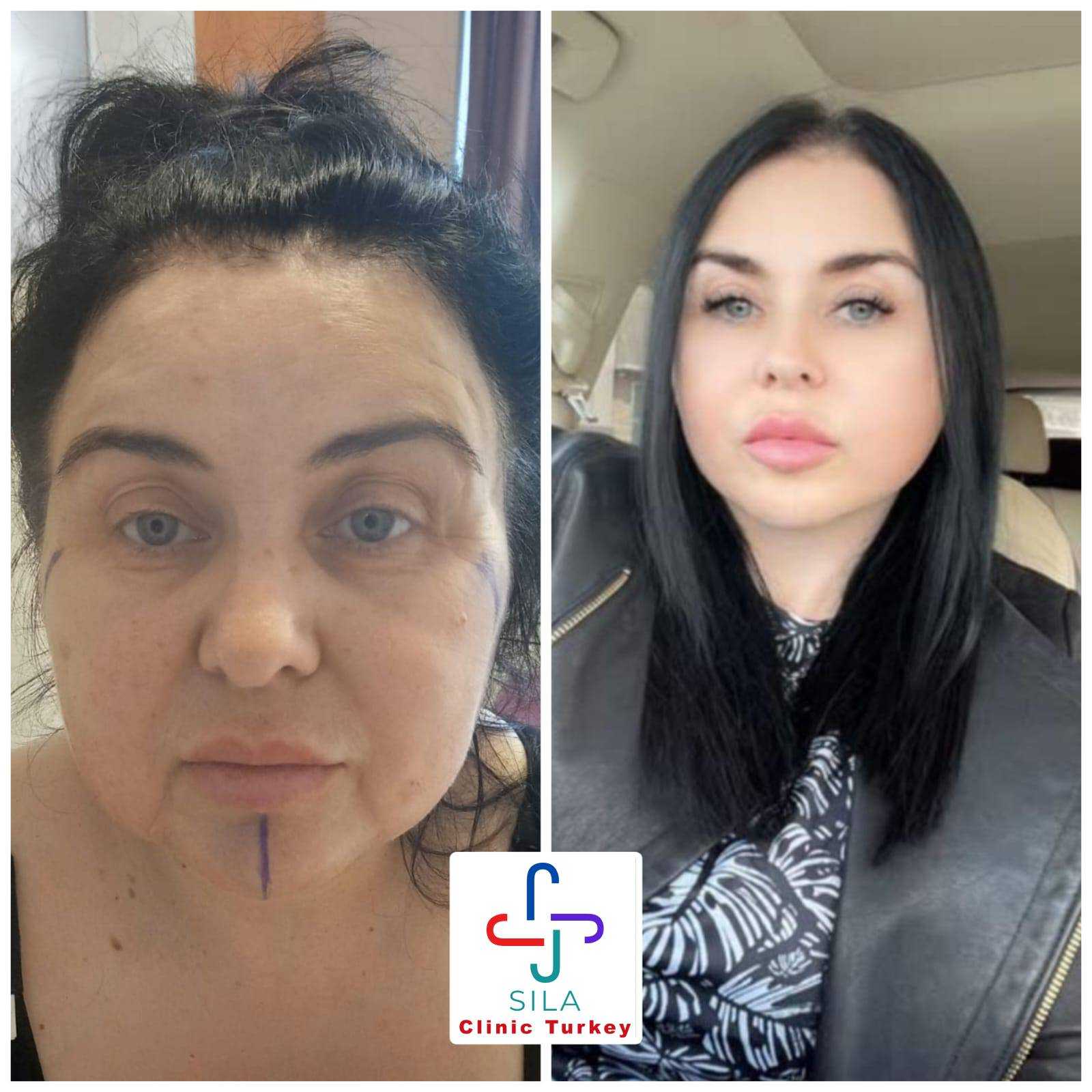 Boyun Germe -  Image 3