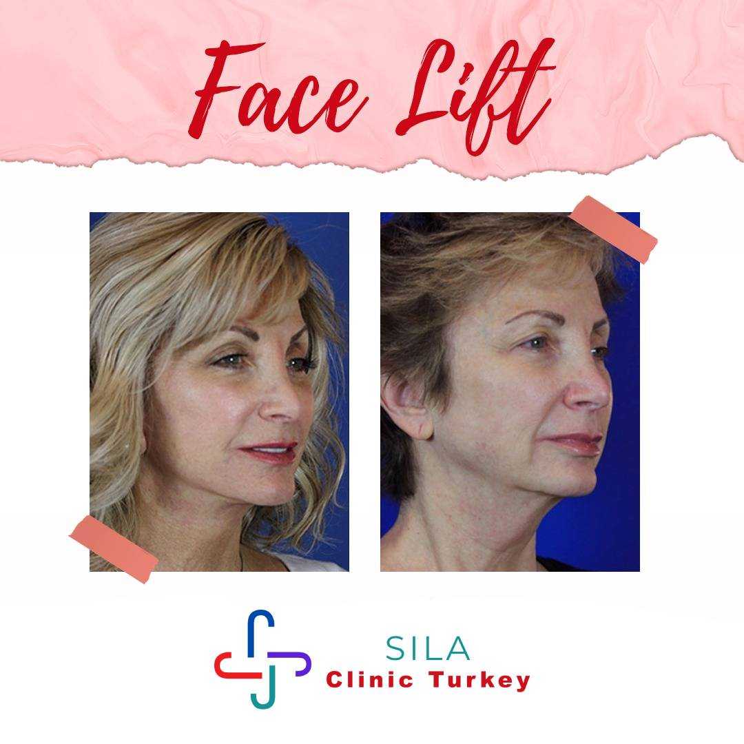 Boyun Germe - Before After