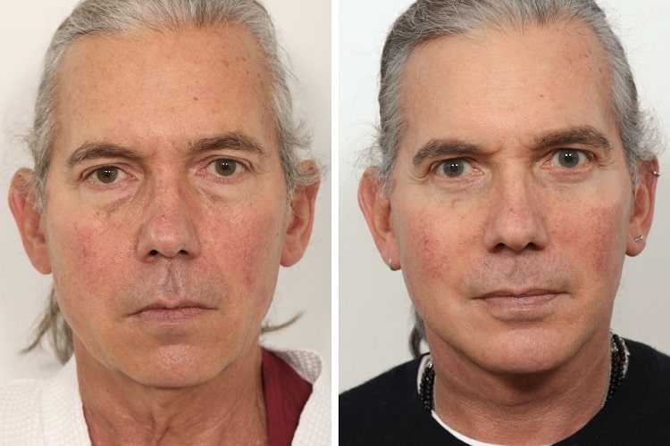 Boyun Germe -  Image 4