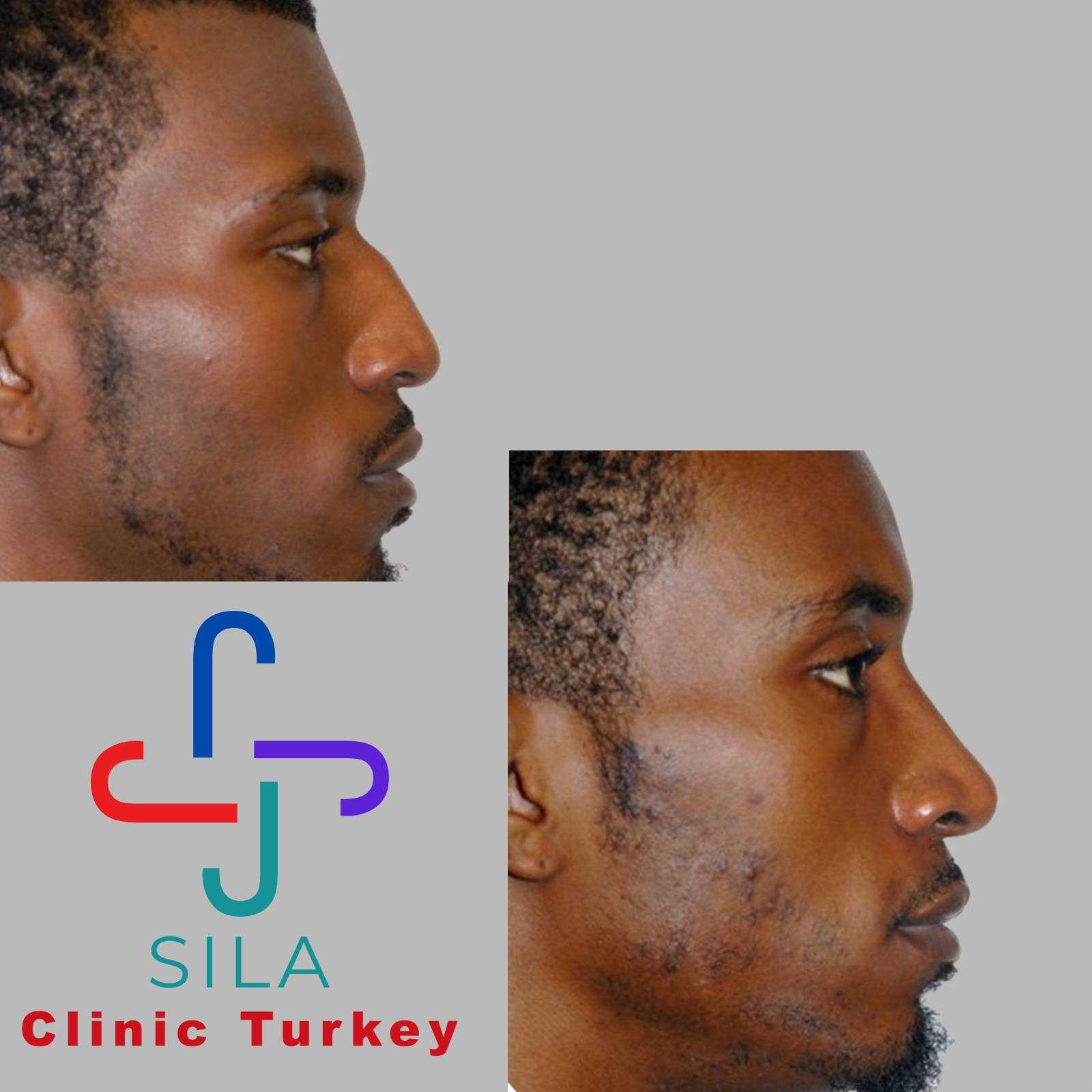 Etnik Burun Estetiği -  Image 1