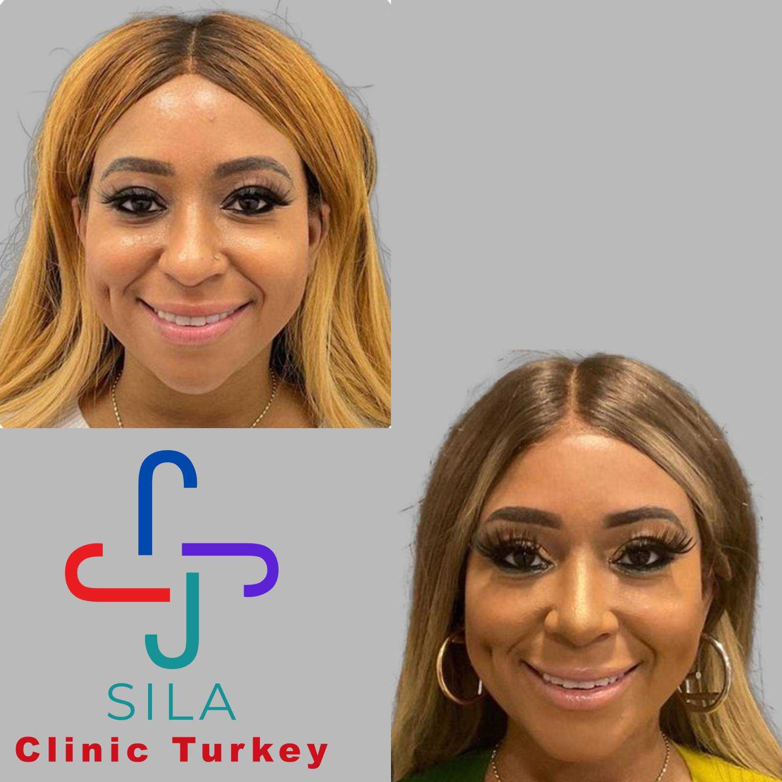 Etnik Burun Estetiği - Before After