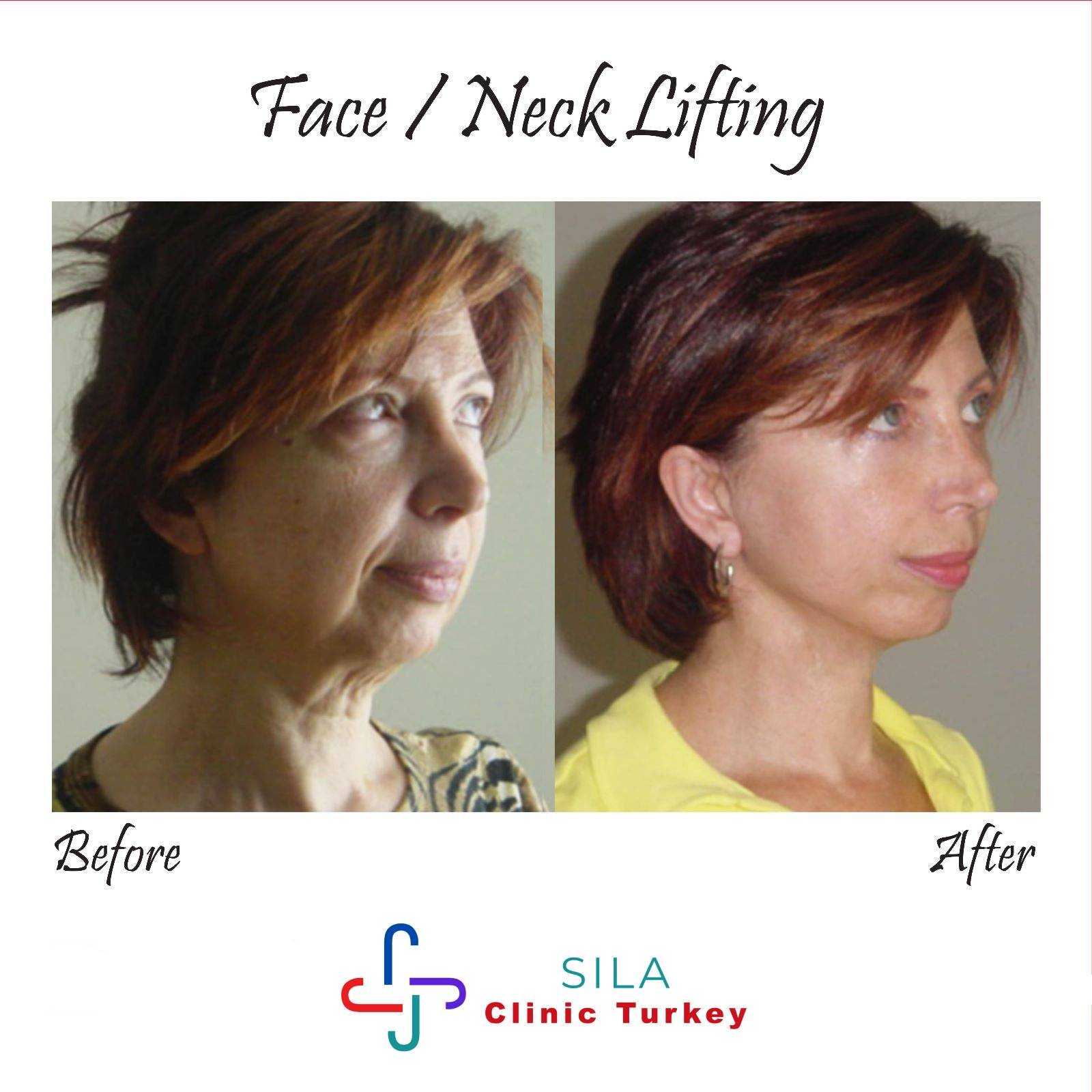 Yüz Germe - Image 2