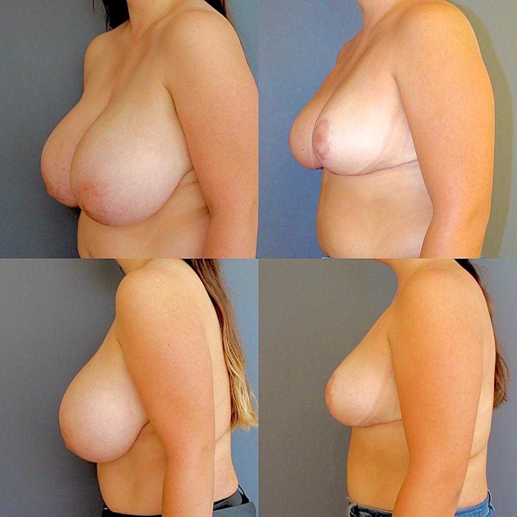 Meme Küçültme -  Image 2