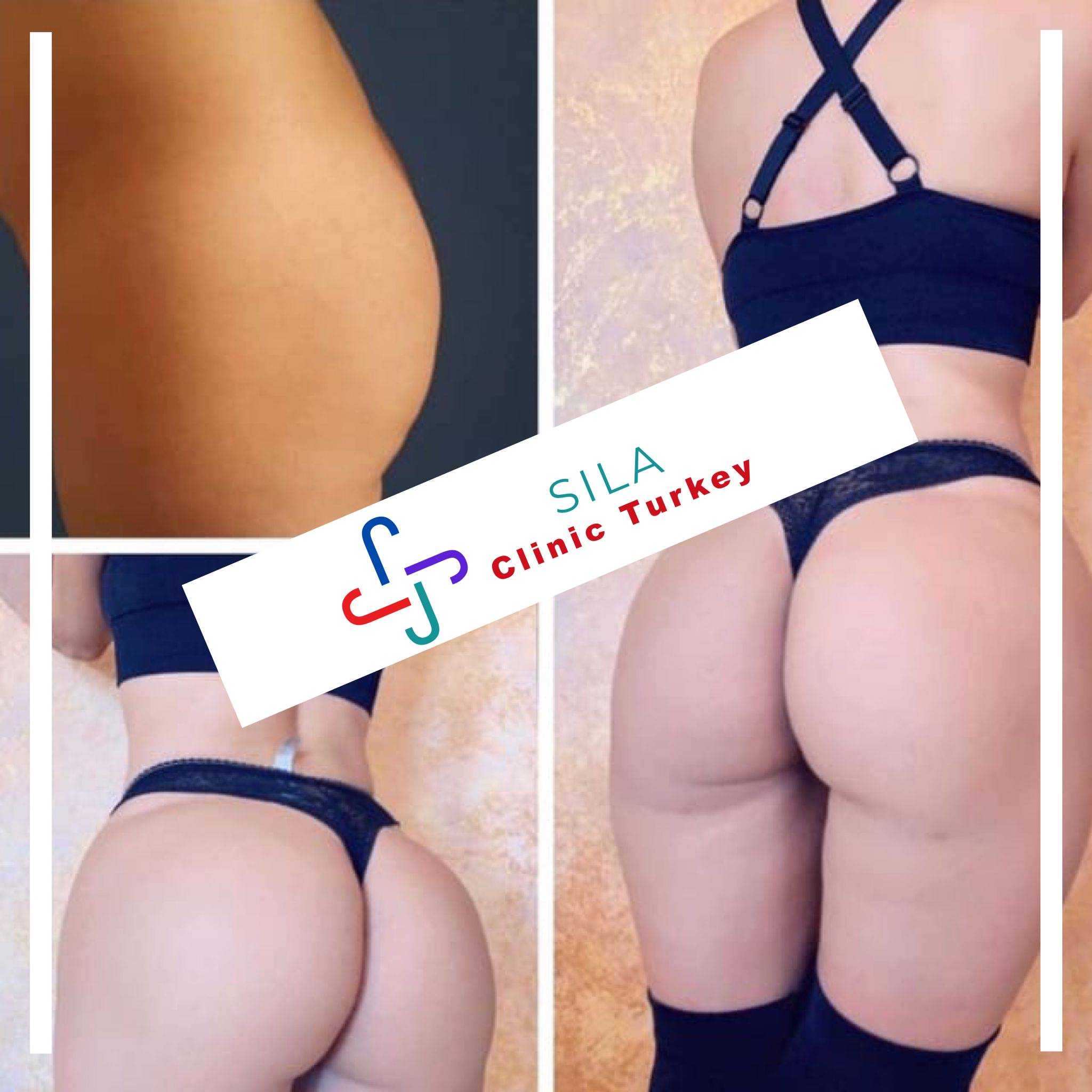 Brezilya Popo Kaldırma -  Image 1