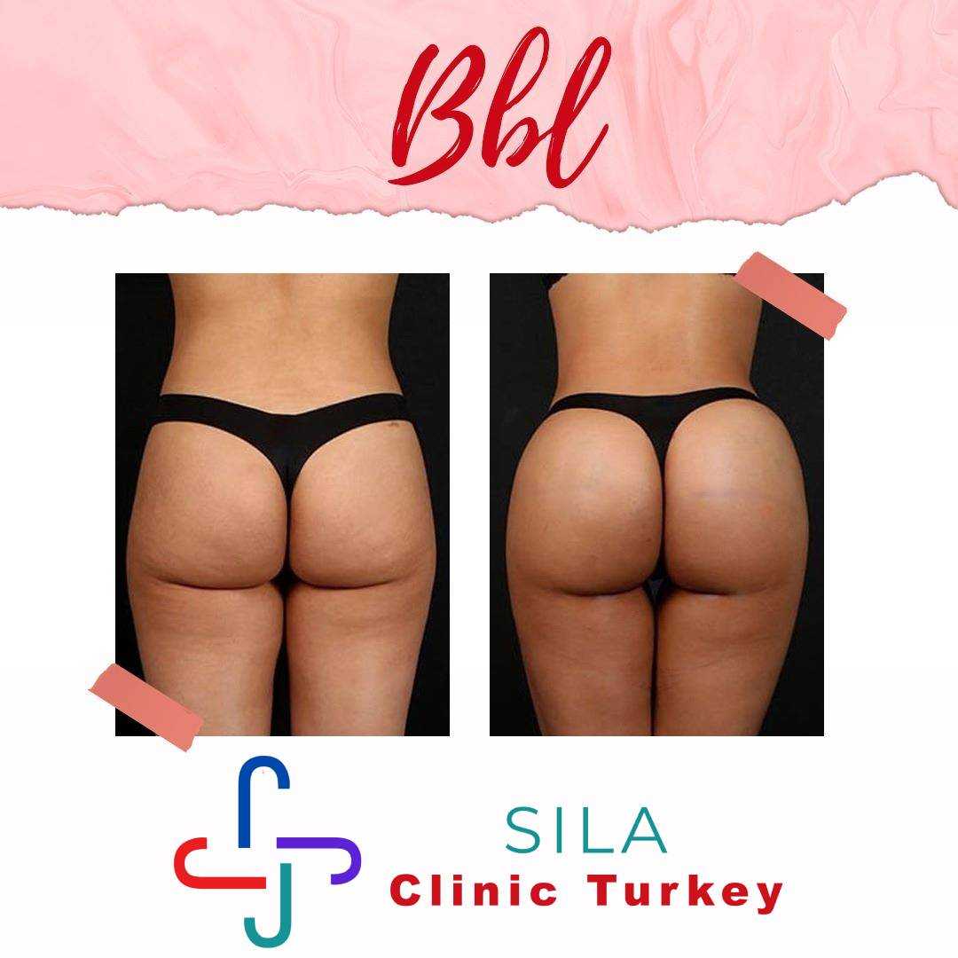 Brezilya Popo Kaldırma - Before After