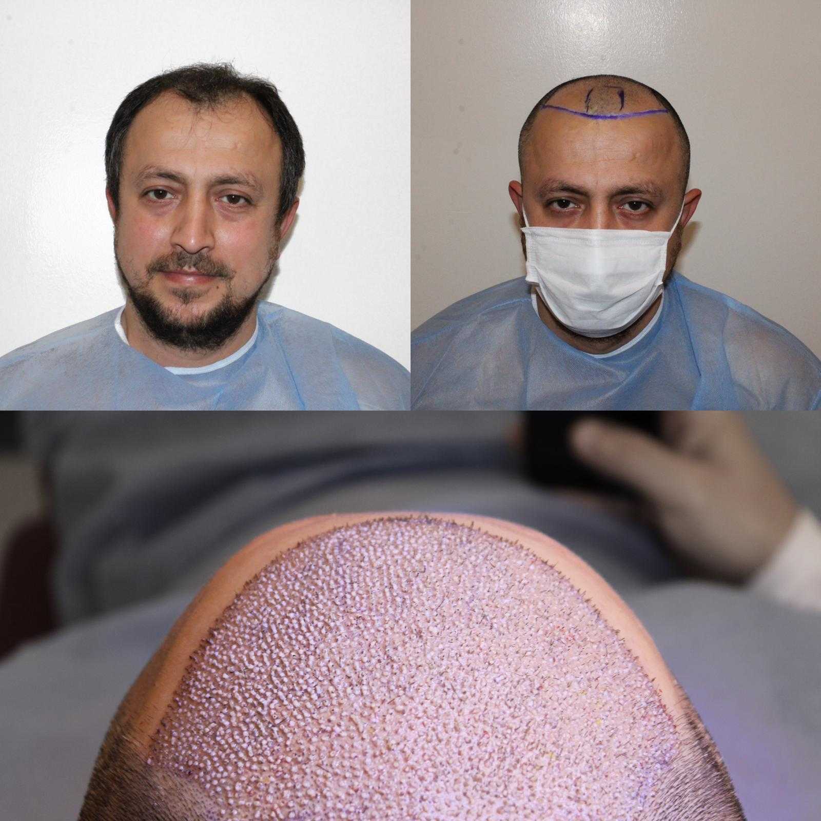 Organik Saç Ekimi - Before After