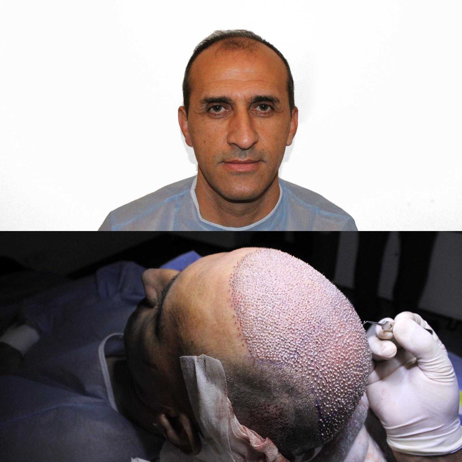 Organik Saç Ekimi -  Image 1